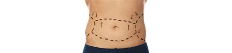 tijuana tummy tuck cost|Tummy Tuck in Tijuana – Mexico